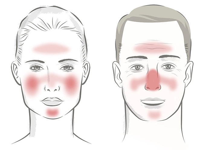 The Faces of Rosacea