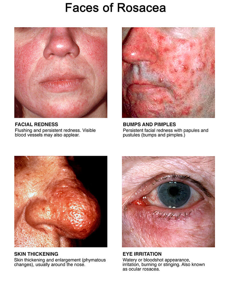 faces of rosacea