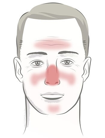 male face of rosacea