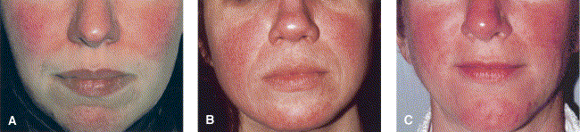 Subtype 1: erythematotelangiectatic rosacea