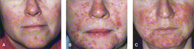 Subtype 2: papulopustular rosacea