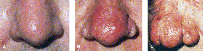 Subtype 3: phymatous rosacea