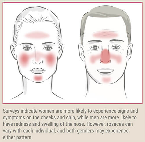 common patterns of rosacea redness