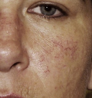 rosacea telangiectasia