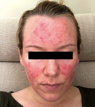 patient with papulopustular rosacea