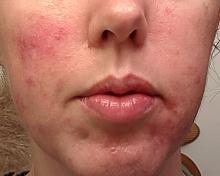 rosacea patient with erythema and dryness